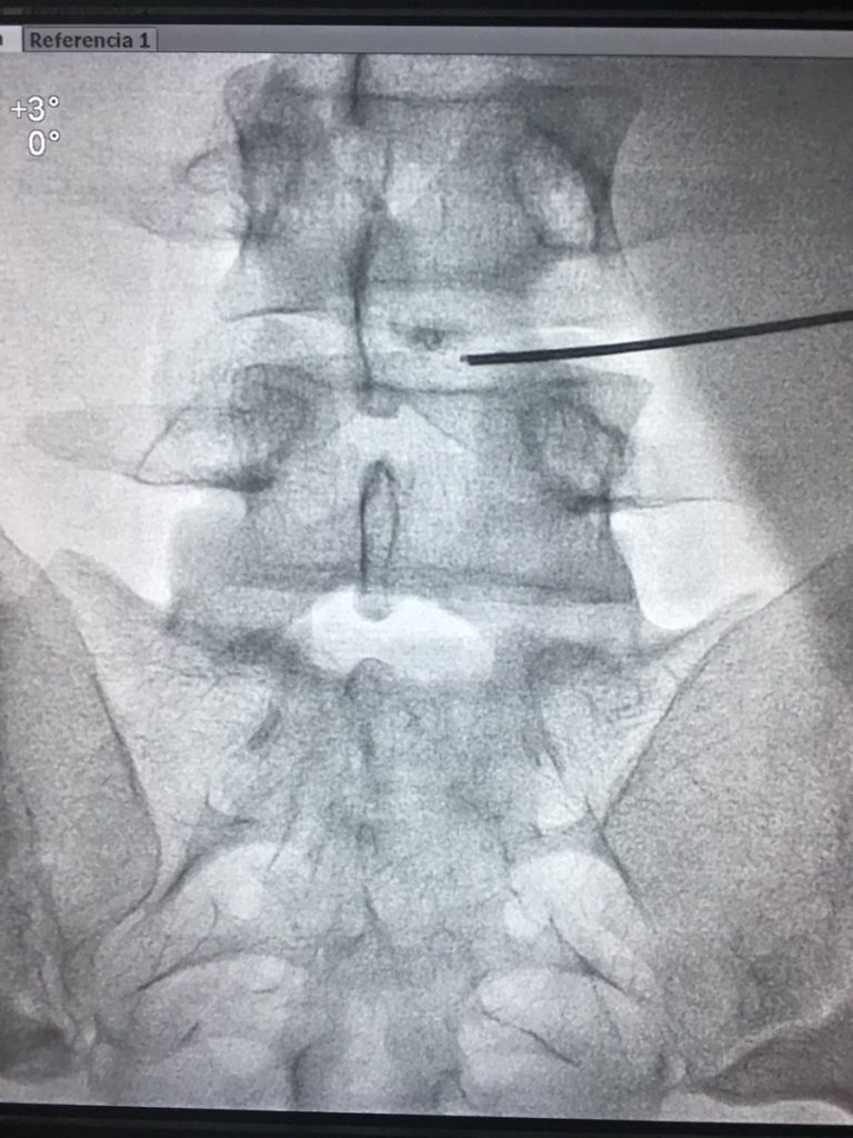 DISK PLASTY